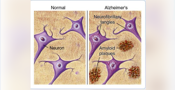 HEALTH TIP from Dr. Vliet: What is Amyloidosis?